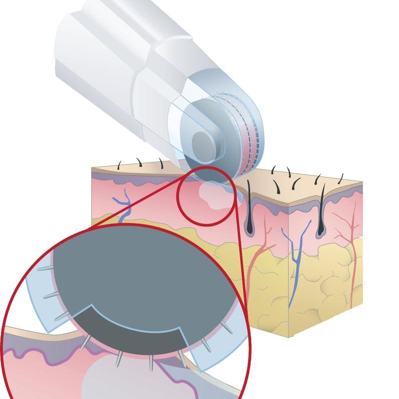 Dermafrac C